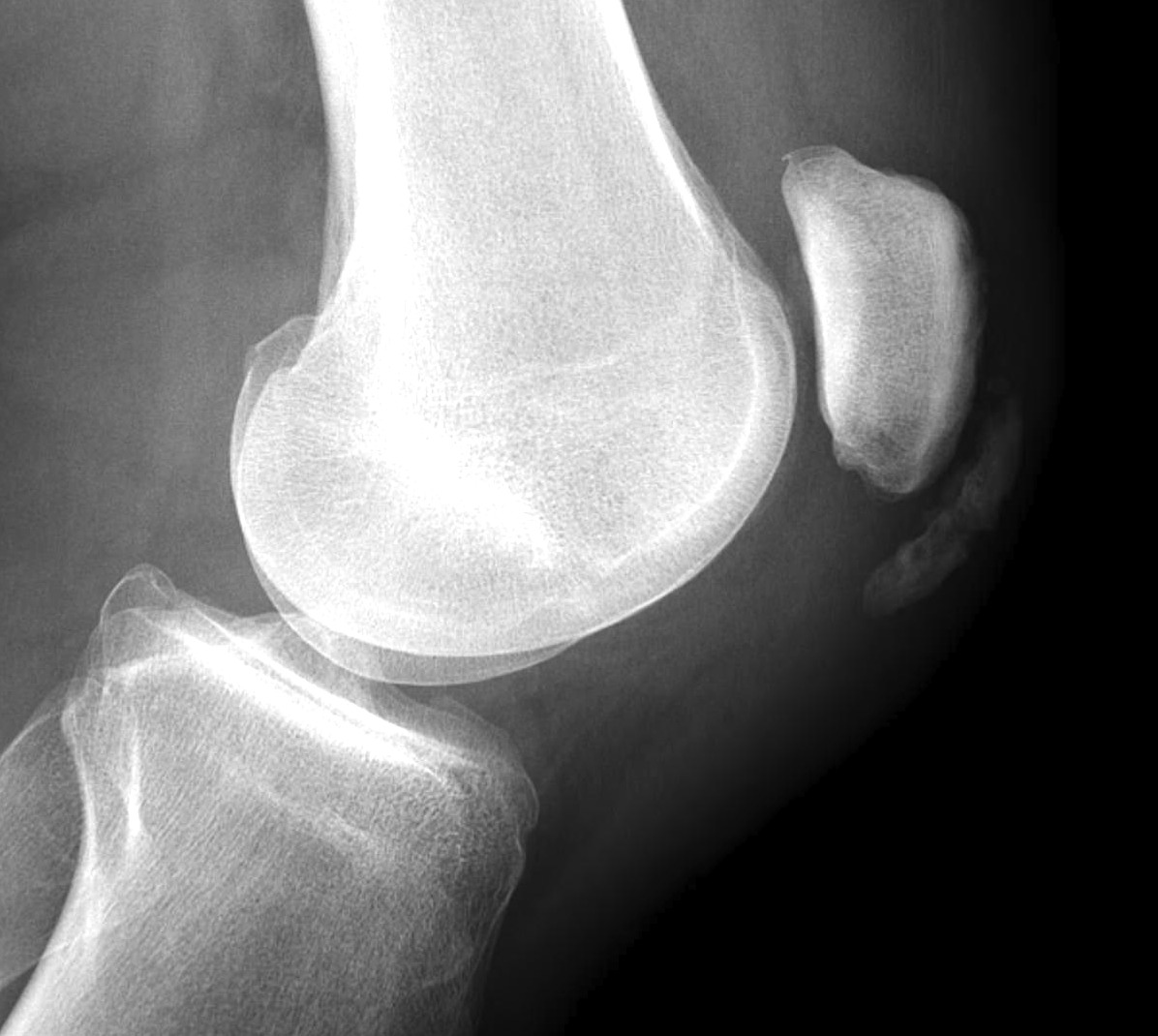 Prepatella Bursitis Xray